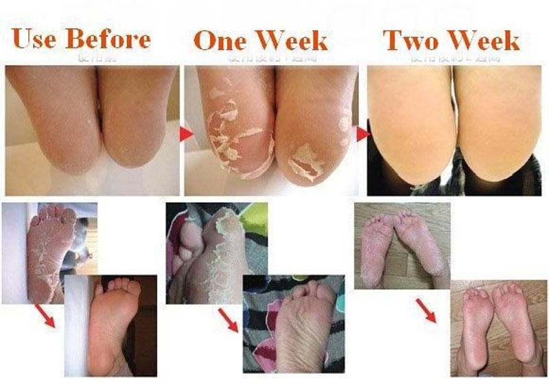 3packs=6pcs Baby Foot Peeling Renewal Foot Mask Remove Dead Skin